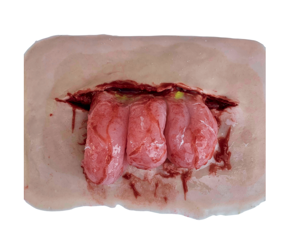 Муляж посттравматичної евентрації кишківника