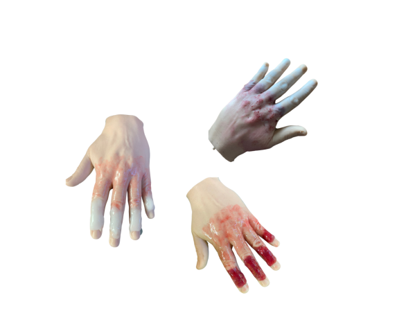 Імітатори обморожень пальців кисті руки 1-го, 2-го і 3-го ступенів