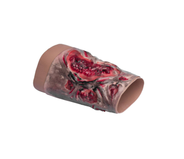 Муляж опіку кінцівки 2-3 ступенів