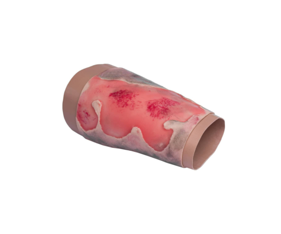 Муляж опіку кінцівки 3-4 ступенів