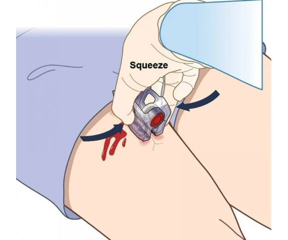 Пристрій для закриття ран 